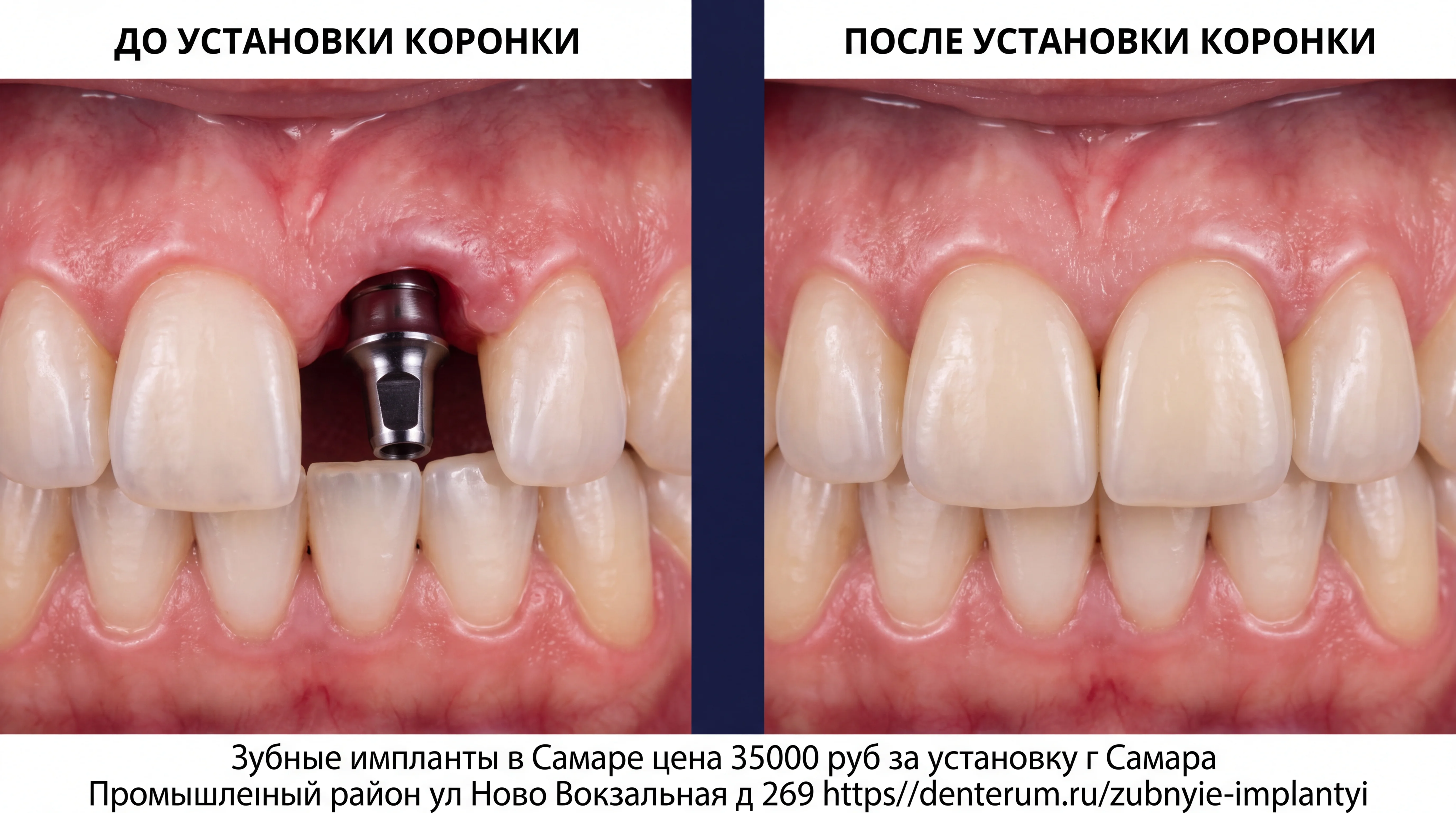 результат протезирования зубов на импланте фото до и после протезирования коронкой на имплантанте переднего зуба парная медицинская иллюстрация, демон...